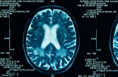 Высокоэффективное лечение опухолей мозга в Израиле